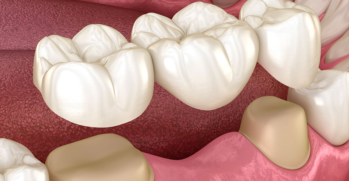 Prothèse dentaire fixe: le bridge