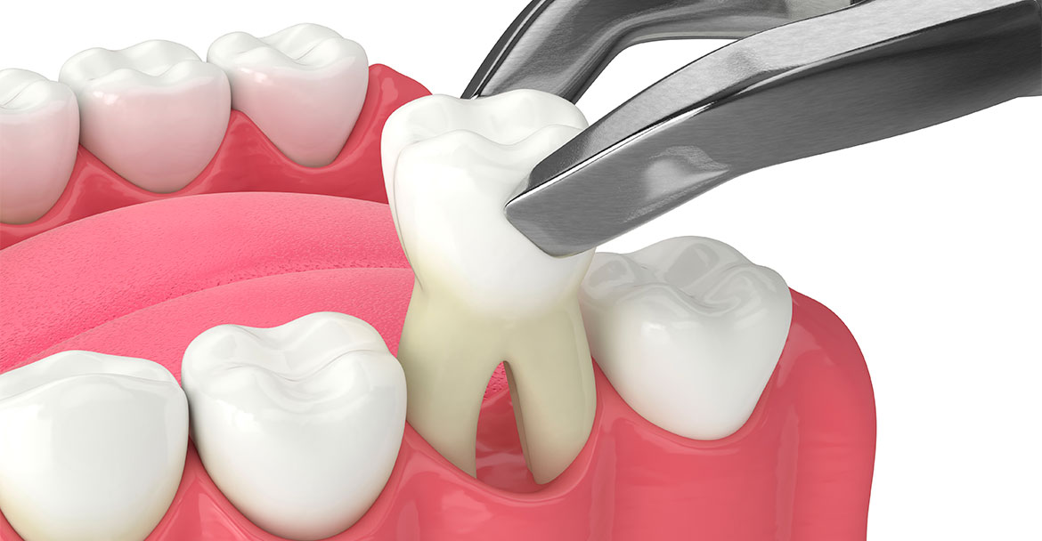 Illustration d'une extraction de molaire